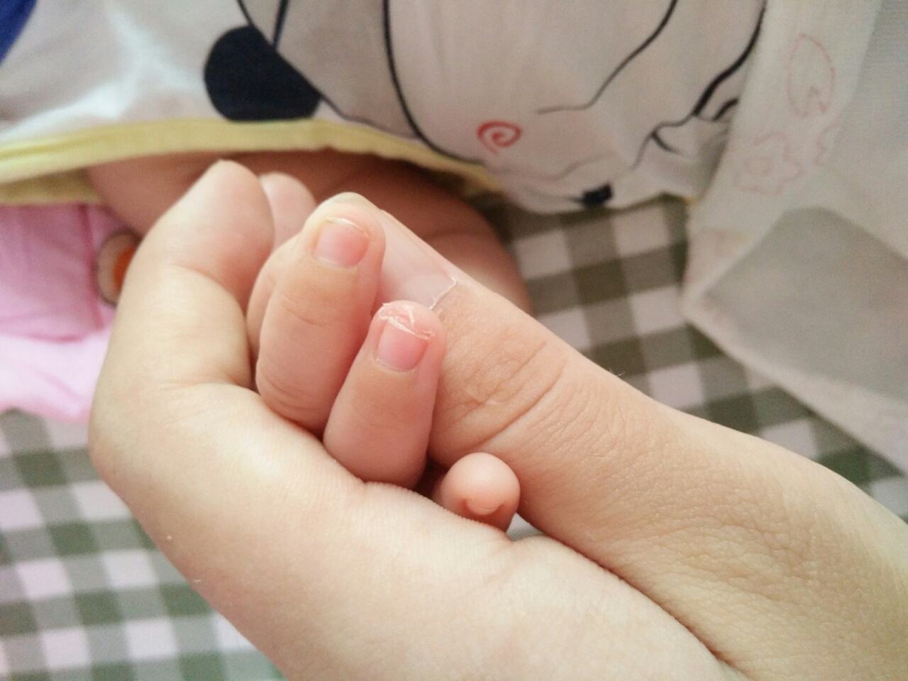 孩子指甲有白斑、凹陷 應該補哪些微量元素